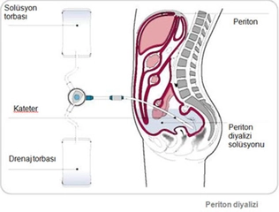Periton Diyalizi Periton Diyalizi